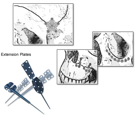 Extension Plates